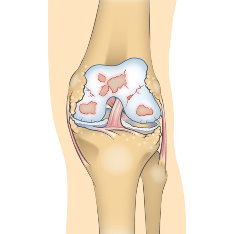 Knee Pain (knee Osteoarthritis) stage4 | Global Health