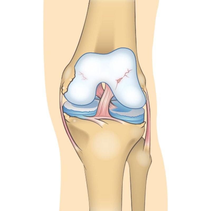 Knee Pain (knee Osteoarthritis) stage2 | Global Health