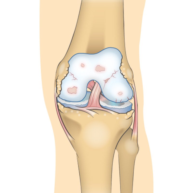 Knee Pain (knee Osteoarthritis) stage3 | Global Health