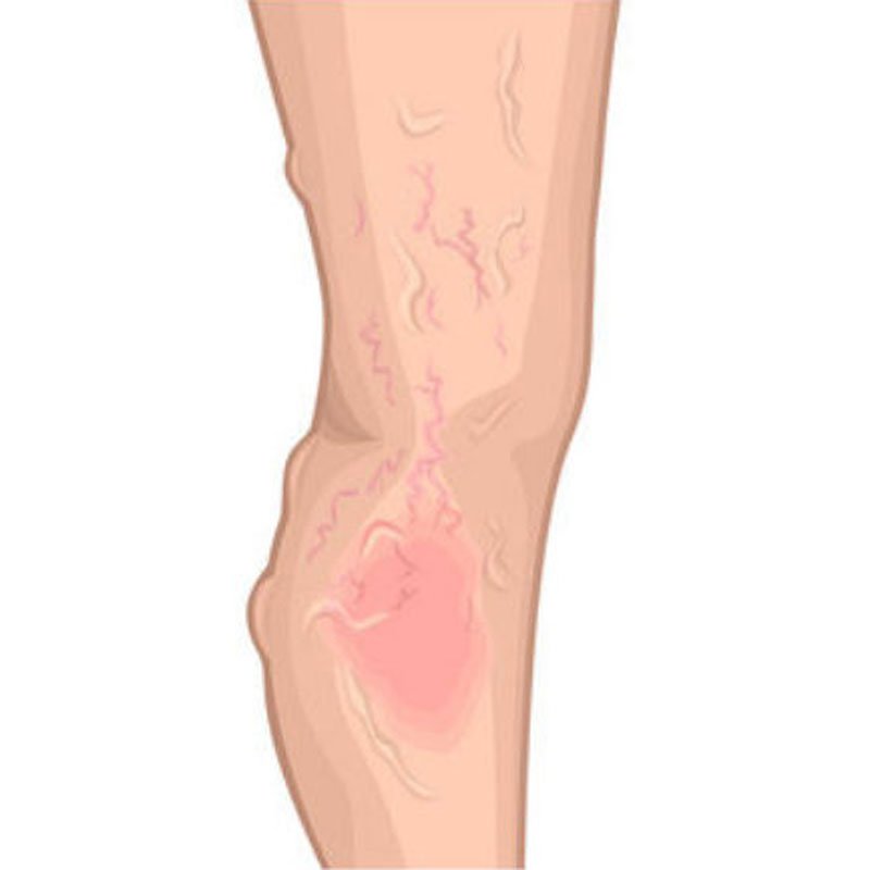 Venous Ulcer stage1 | Global Health