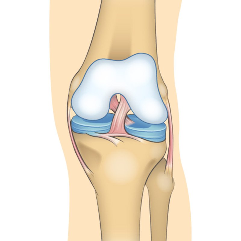 Knee Pain (knee Osteoarthritis) stage1 | Global Health