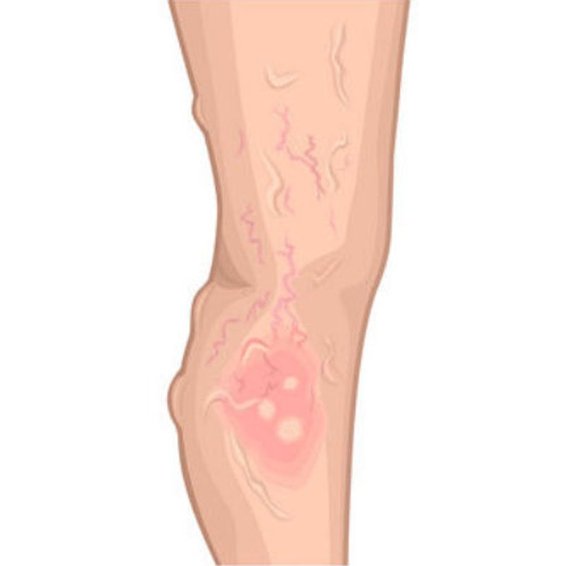 Venous Ulcer stage3 | Global Health