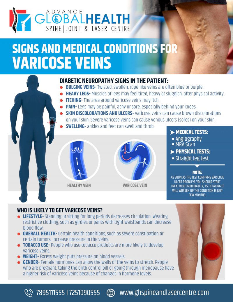 SIGNS AND MEDICAL CONDITIONS FOR VARICOSE VEINS