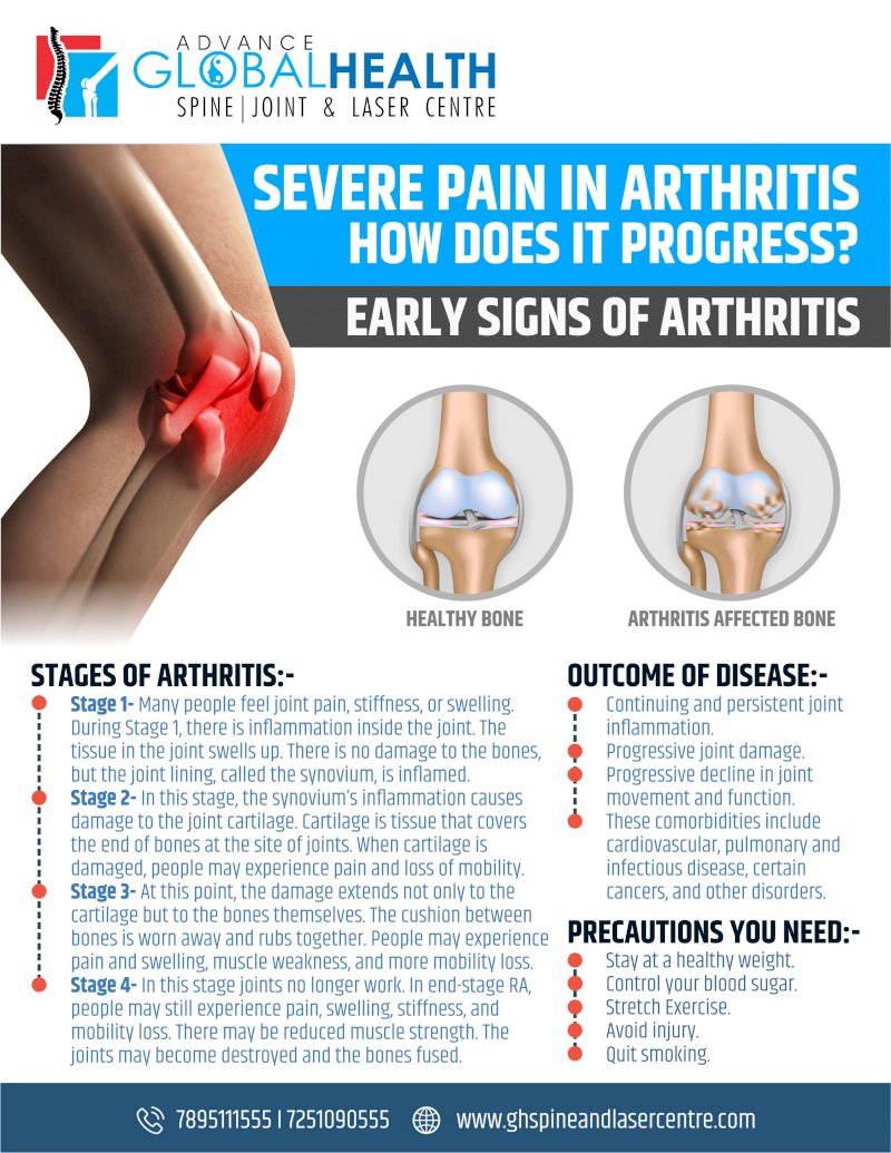  SEVERE PAIN IN ARTHRITIS HOW DOES IT PROGRESS?