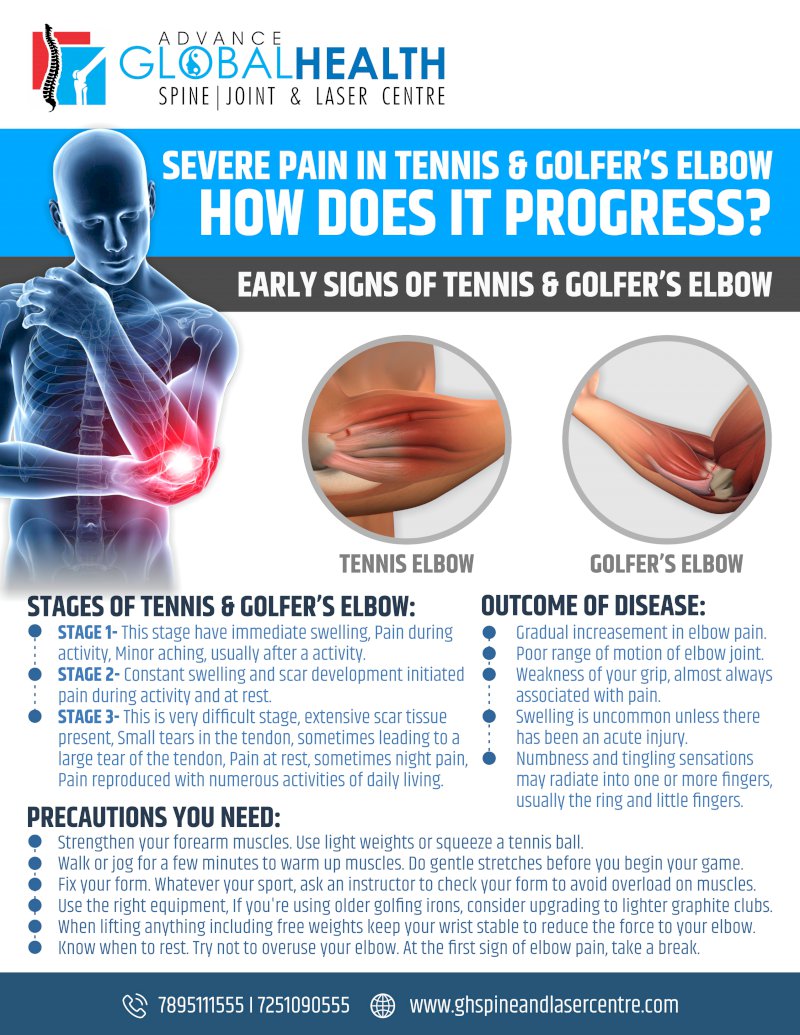 SEVERE PAIN IN TENNIS & GOLFER’S ELBOW HOW DOES IT PROGRESS?