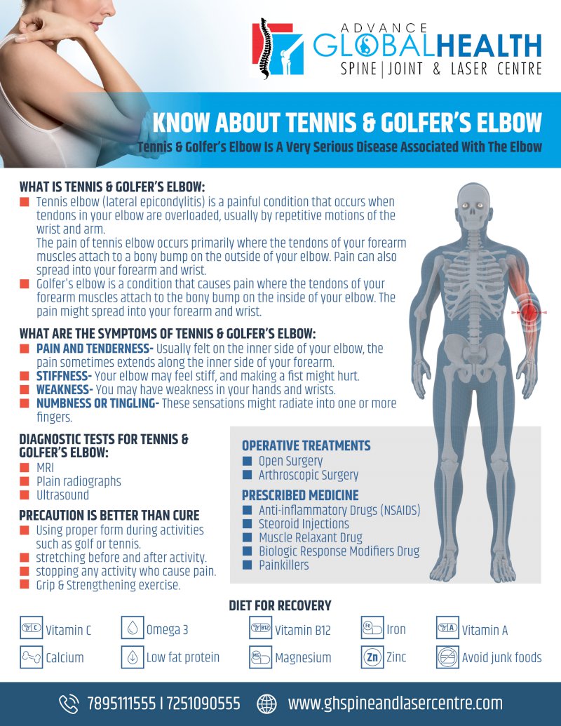 KNOW ABOUT TENNIS & GOLFER’S ELBOW: Tennis & Golfer’s Elbow Is A Very Serious Disease Associated With The Elbow