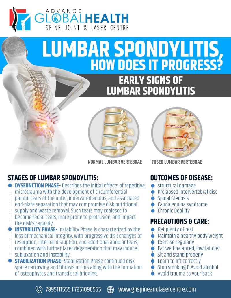 LUMBAR SPONDYLITIS HOW DOES IT PROGRESS?