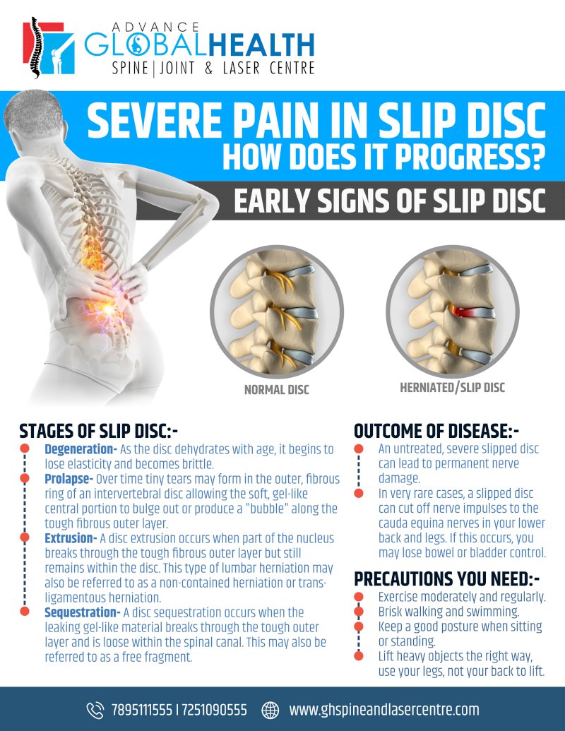 SEVERE PAIN IN SLIP DISC, HOW DOES IT PROGRESS?