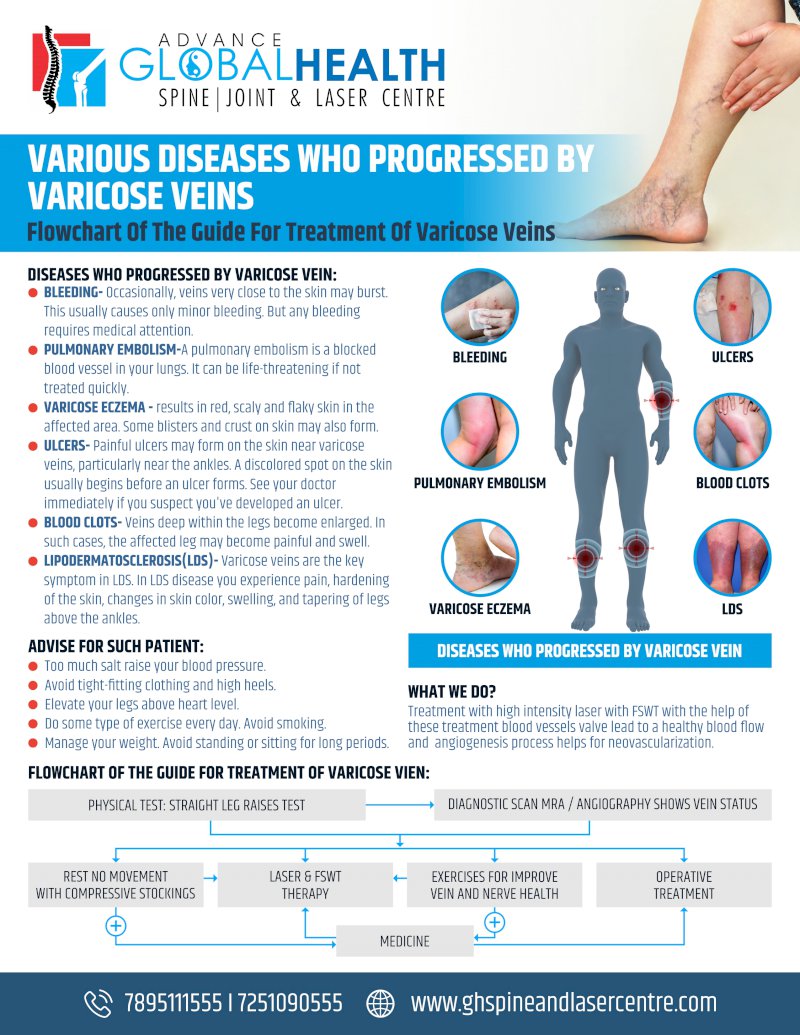 VARIOUS DISEASES WHO PROGRESSED BY VARICOSE VEINS: Flowchart Of The Guide For Treatment Of Varicose Veins