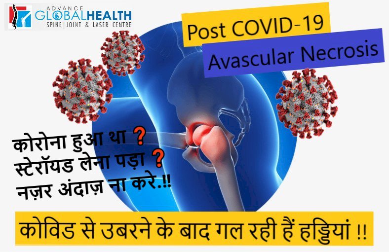 Post COVID-19 AVN(Avascular Necrosis)