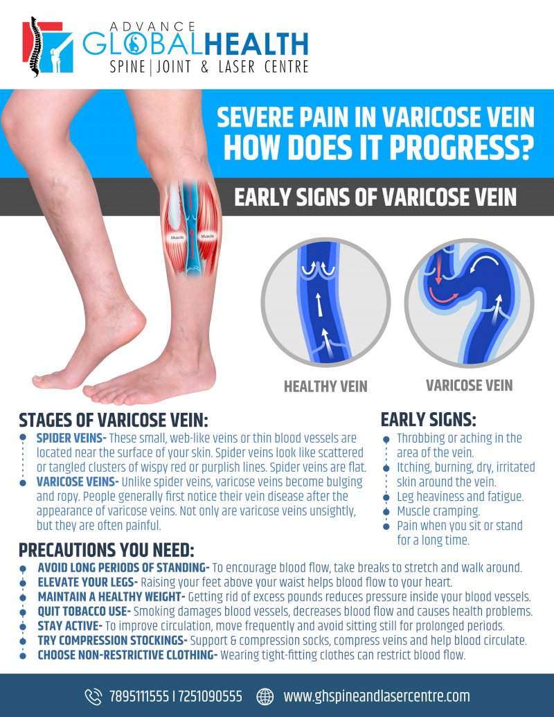 SEVERE PAIN IN VARICOSE VEIN HOW DOES IT PROGRESS: EARLY SIGNS OF VARICOSE VEIN