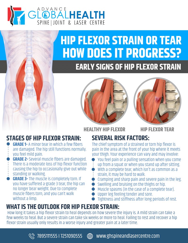Hip Strain, Symptoms & Treatment for Hip Flexor Strains