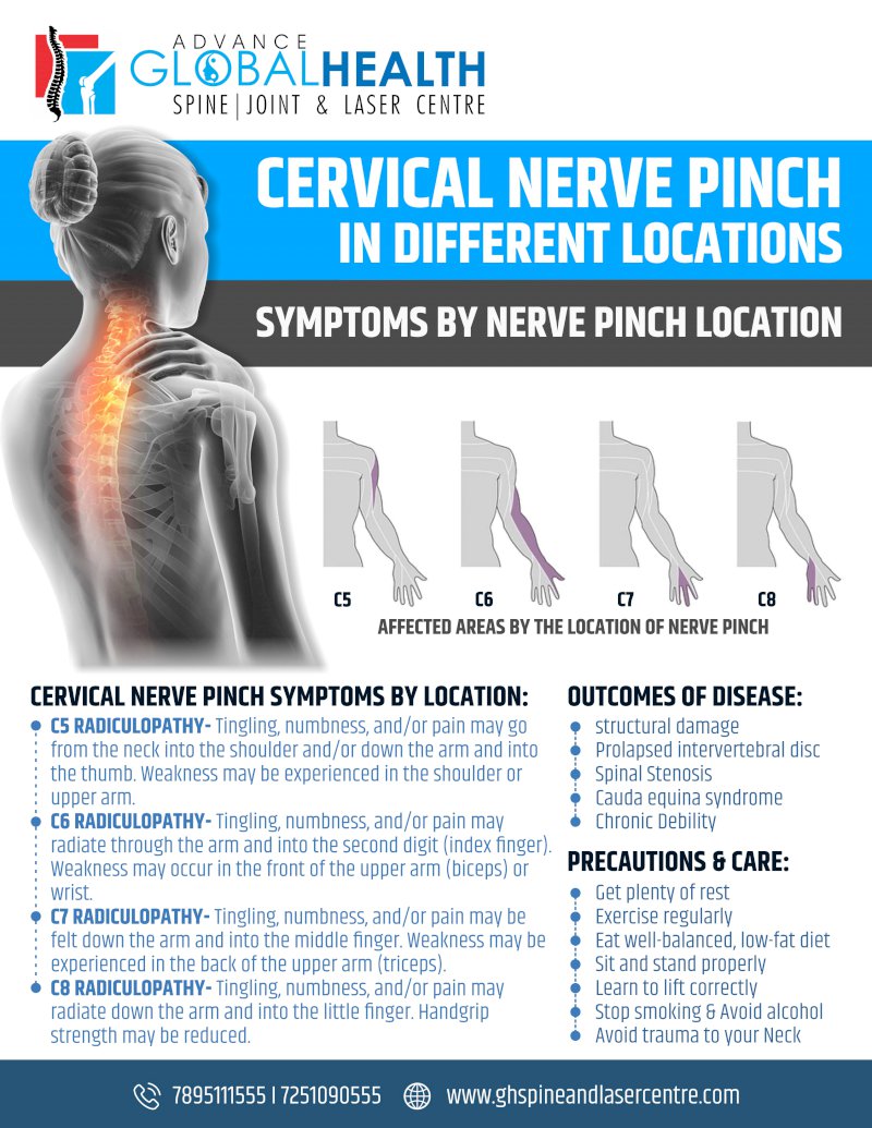 CERVICAL NERVE PINCH IN DIFFERENT LOCATIONS: SYMPTOMS BY NERVE PINCH LOCATION