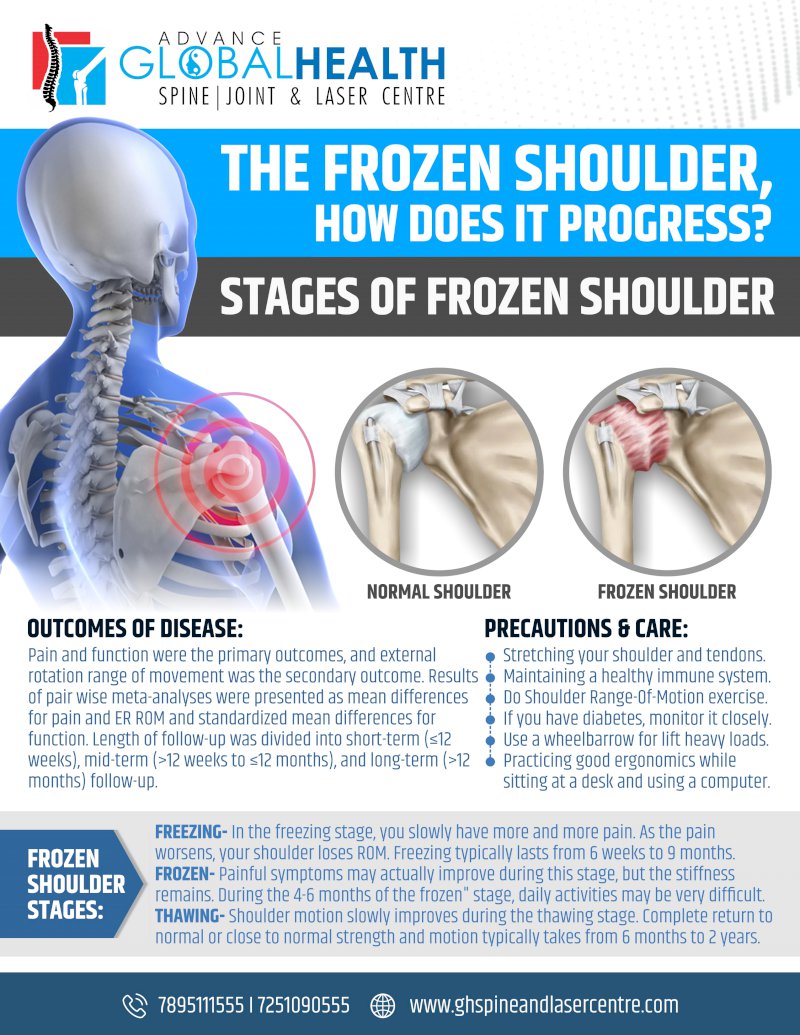 THE FROZEN SHOULDER, HOW DOES IT PROGRESS: STAGES OF FROZEN SHOULDER