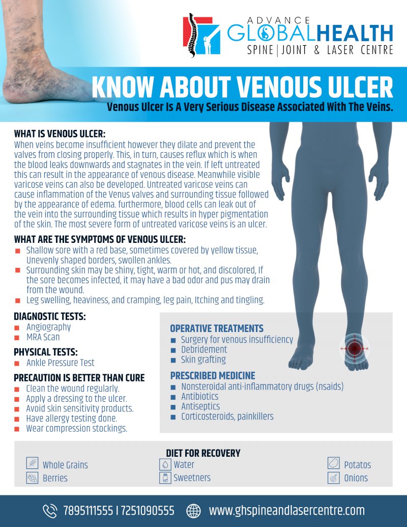 KNOW ABOUT VENOUS ULCER: Venous Ulcer Is A Very Serious Disease Associated With The Veins