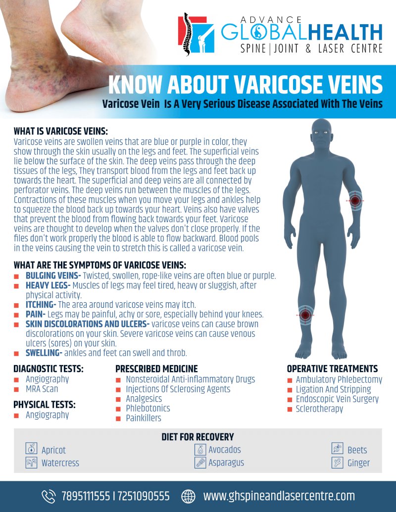 KNOW ABOUT VARICOSE VEINS: Varicose Vein  Is A Very Serious Disease Associated With The Veins