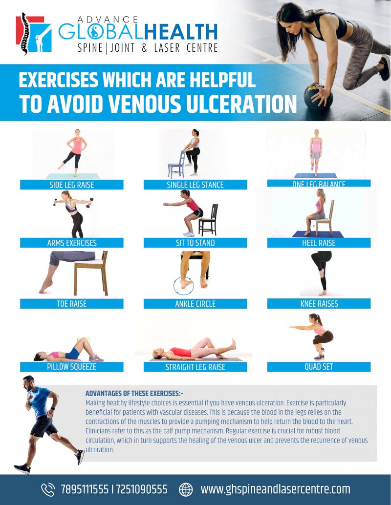 EXERCISES WHICH ARE HELPFUL TO AVOID VENOUS ULCERATION