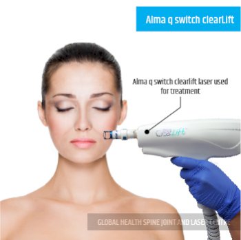 Alma q switch clearLift Treatment | Global Health