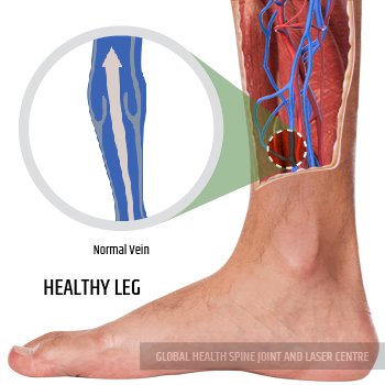 HEALTHY LEG | Global Health