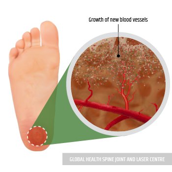 GROWTH OF NEW BLOOD VESSELS | Global Health