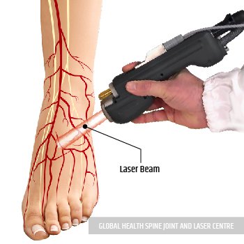 LASER TREATMENT | Global Health