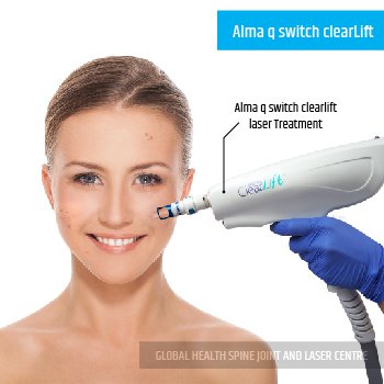 Alma q switch clearLift LASER TREATMENT | Global Health
