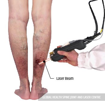 LASER TREATMENT | Global Health