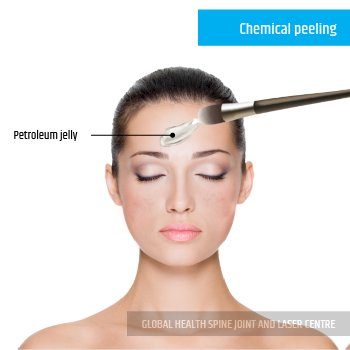  Chemical peeling  | Global Health