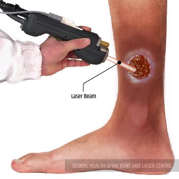 LASER TREATMENT | Global Health