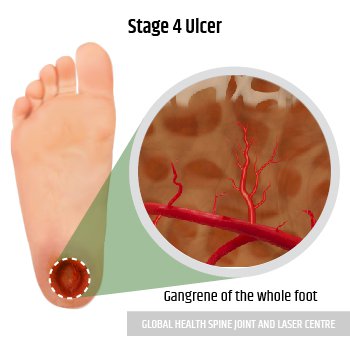 Diabetic Foot Ulcer Stages 2nd MTP region - Podiatry Doctor