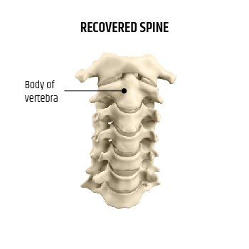 RECOVERED SPINE | Global Health