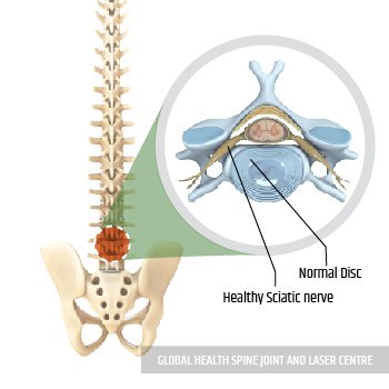 Healthy Disc & sciatic nerve | Global Health