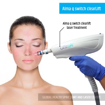 Alma q switch clearLift | Global Health