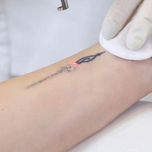 Tattoo Removing | Global Health